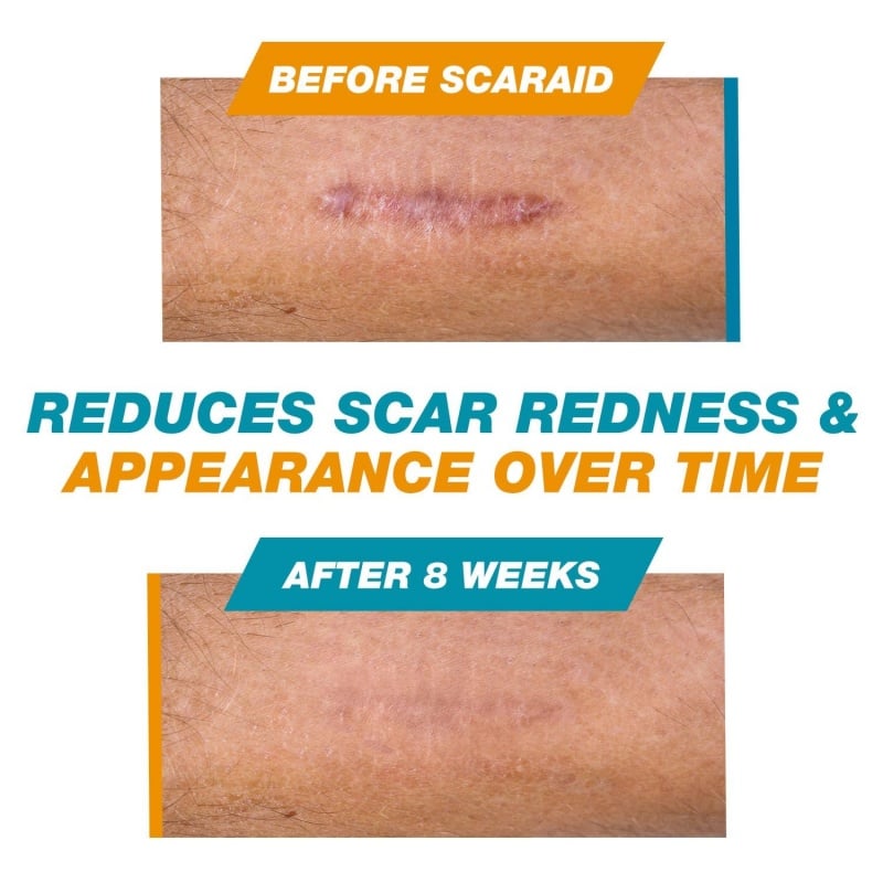 Skin Scar Solutions🛡️ 60%  Silicone Scar Stick.